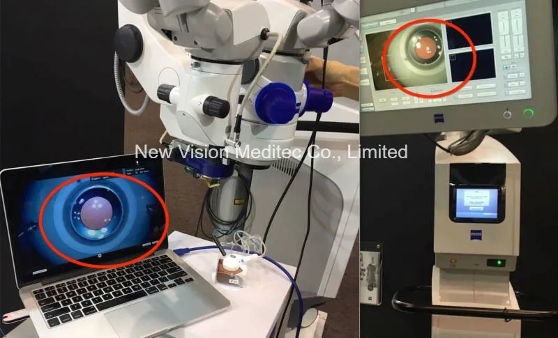FHD Video Camera for Digitalizing Surgical Operation Microscope
