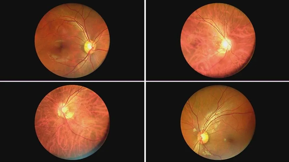 Portable Non-Mydriatic Fundus Camera for Ophthalmology, Non-Mydriatic for Fundus Camera Portable Type